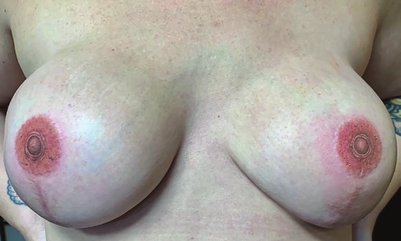 File:Becker Cassisi breasts 1, after.png