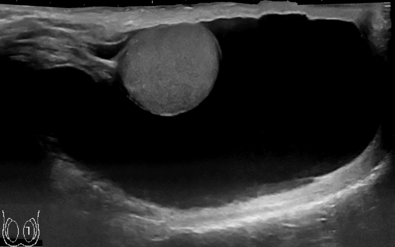 Scrotal ultrasound of a 1 dm large hydrocele, with anechoic (dark) fluid surrounding the testicle.