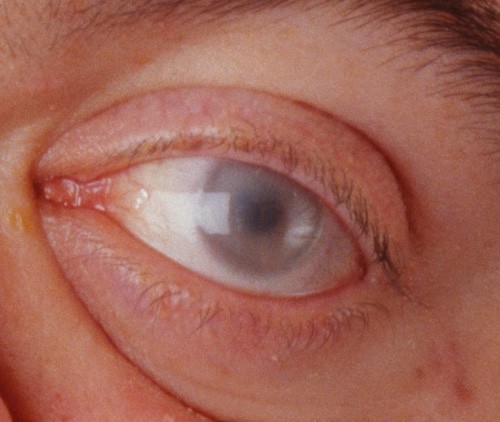 File:Corneal Clouding in MPS-VI (Maroteaux-Lamy Syndrome).jpg