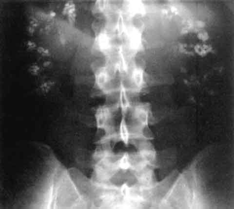 Файл:Nephrocalcinosis.jpg