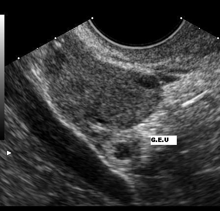 Archivo:Ectopic pregnancy.JPG