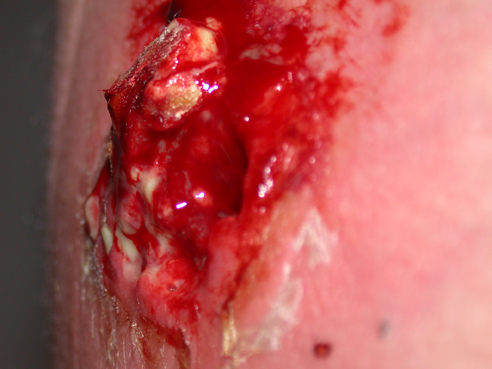 File:Mrsa cyst exploded.jpg