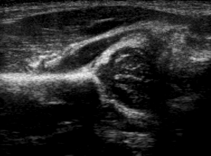 File:Ultrasound Scan ND 0114142455 1429140 crop.png