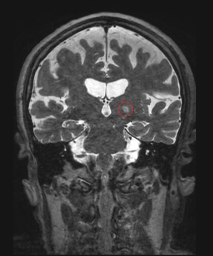 Archivo:MRI-guided HIFU, essential tremor, 10-14 135, pointed.png