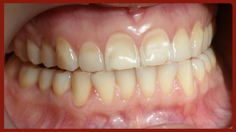 Файл:Dental erosion (hypoestrogenia) no211.jpg