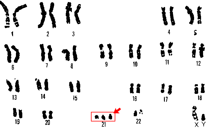 Файл:21 trisomy - Down syndrome.png