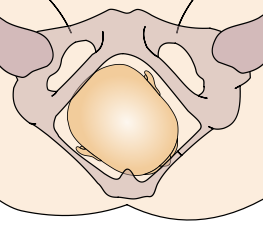 Archivo:Cephalic presentation - right occipito-anterior.png