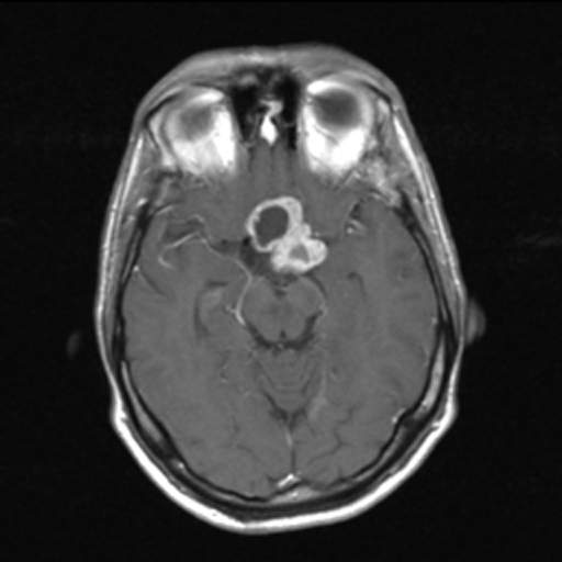 Файл:Craniopharyngioma-t1axkm-003.jpg