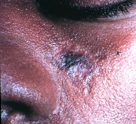 File:Discoid lupus erythematosus.JPG