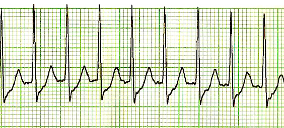 File:SVT Lead II-2.JPG