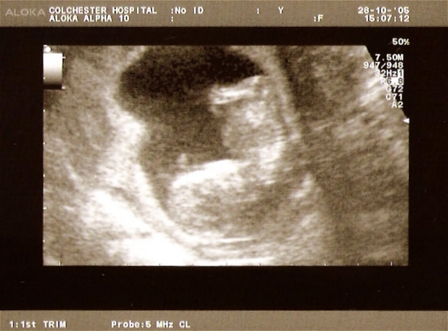 File:Scan12weeks.jpg