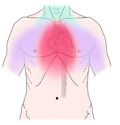 File:Angina pectoris.png