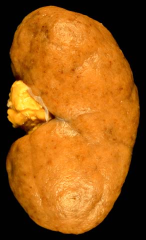 File:Diffuse proliferative lupus nephritis.jpg