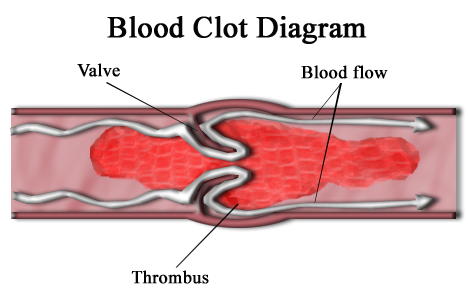 File:Blood clot diagram.png