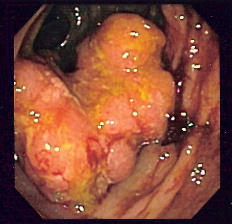 File:Colorectal cancer endo 2.jpg