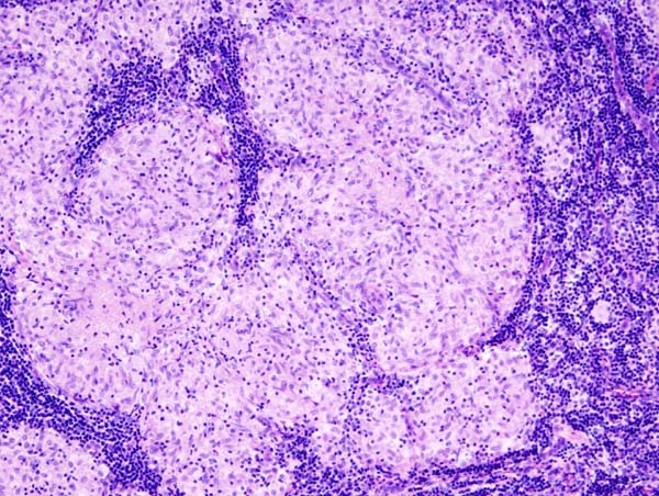 File:Sarcoidosis (1) lymph node biopsy.jpg