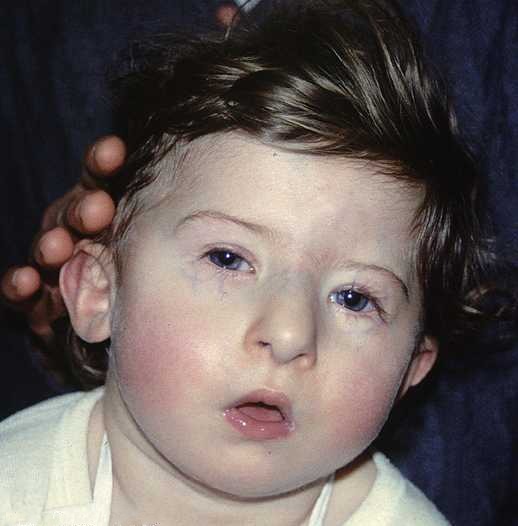 File:DiGeorge syndrome1.jpg