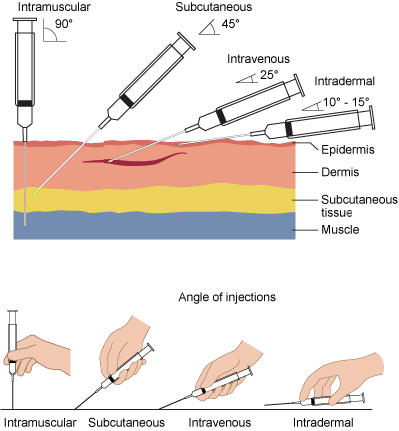 File:Needle-insertion-angles-1 (edited).png