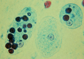 Archivo:Trophozoites of Entamoeba histolytica with ingested erythrocytes.JPG