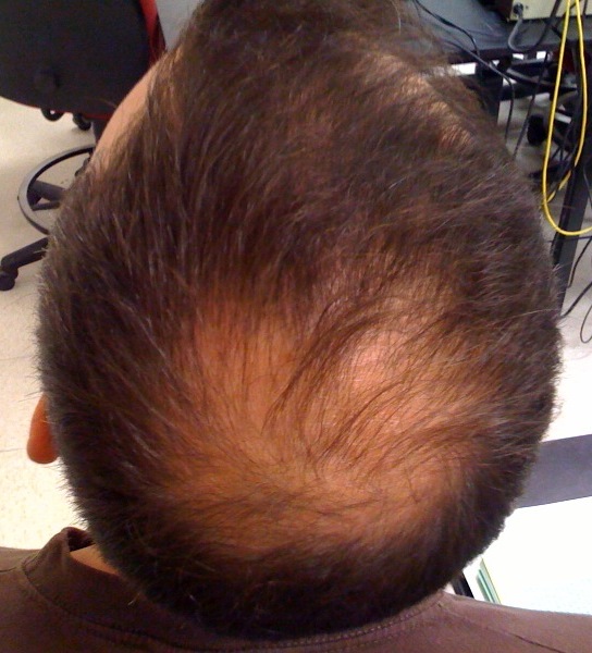 File:Alopecia.jpg