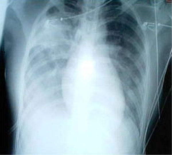 File:SARS xray.jpg