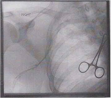 A venogram before catheter-directed thrombolysis against Paget–Schroetter syndrome, a rare and severe arm DVT shown here in a judo practitioner, with highly restricted blood flow shown in the vein