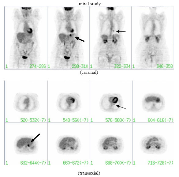 Файл:FDG-PET initial study solitary pulmonary nodule Non-Hodgkin lymphoma.jpg