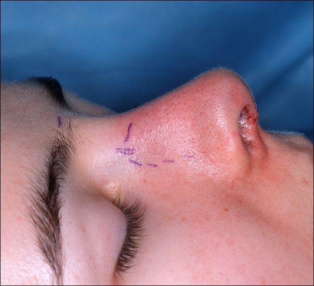 File:RhinoplastySplint1.jpg