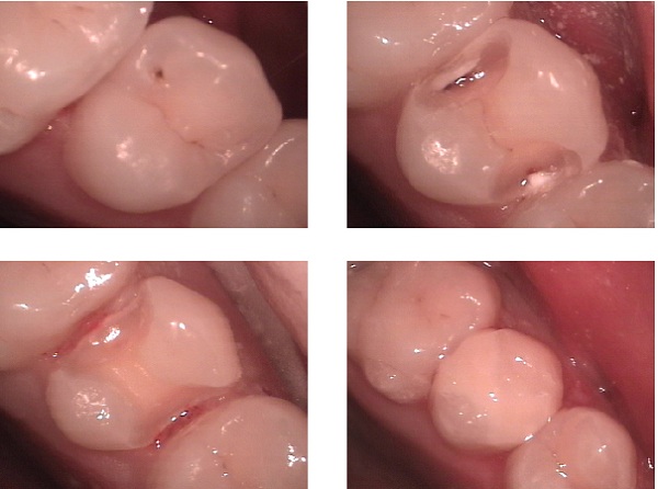 File:Dental Restoration.jpg