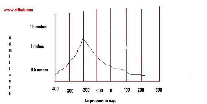 Archivo:Tympanometry Type c.jpg