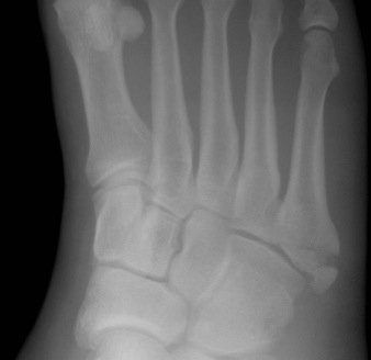 File:Cropped version of JonesFracture1.jpg