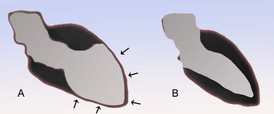 Файл:TakoTsubo scheme.png