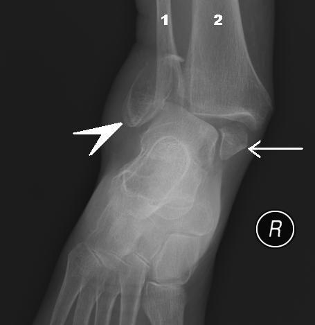 File:Bimalleolar fracture legend.jpg