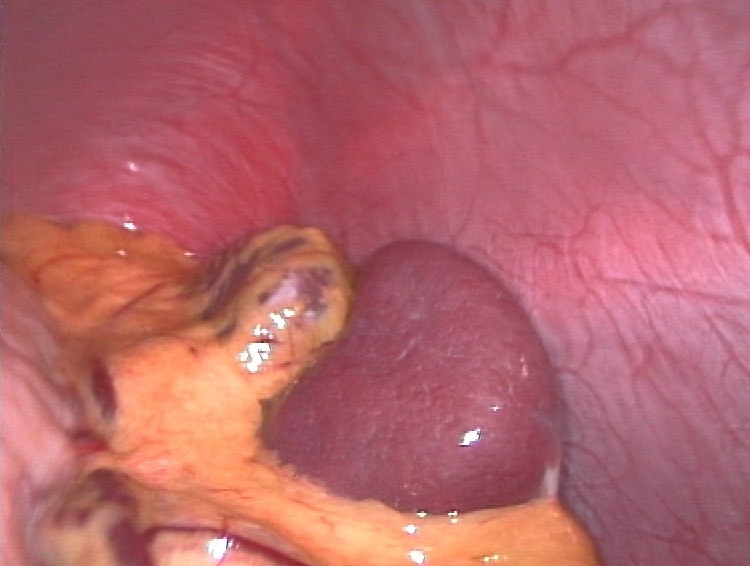 File:Spleen.jpg