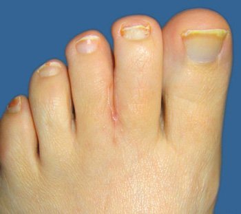 File:Webbed toes after.jpg