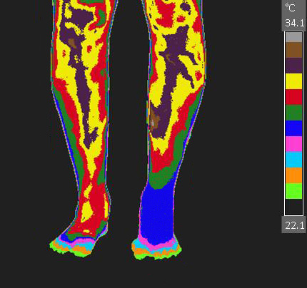 File:CRPS-RSD of the left foot.jpg