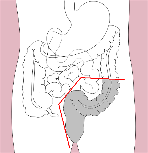 File:Proctosimoidectomy.png