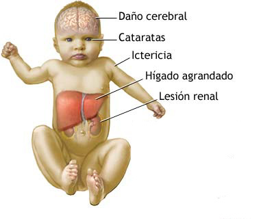 Archivo:Bebe Galactosemia.jpg