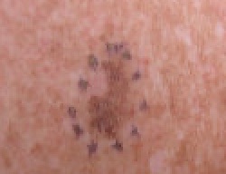 File:Malignant Melanoma in situ Left Anterior Shoulder.jpg