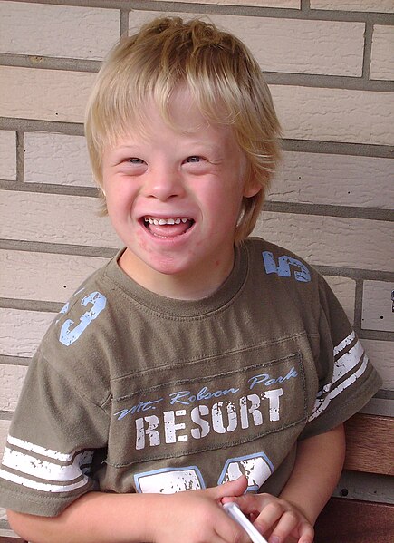 Archivo:Boy with Down Syndrome.JPG