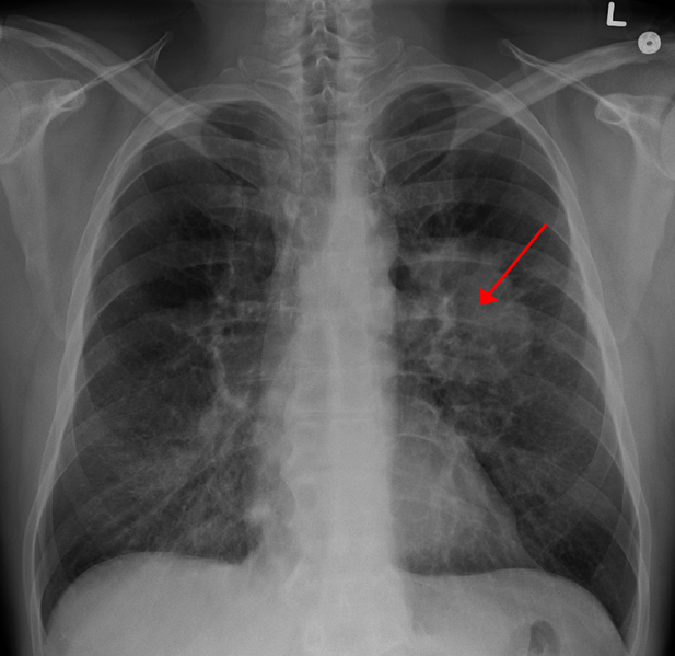 File:LungCACXR.PNG