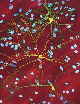 An edited microscopic image of medium spiny neurons (yellow) with nuclear inclusions (orange), which occur as part of the disease process, image width 360 µm