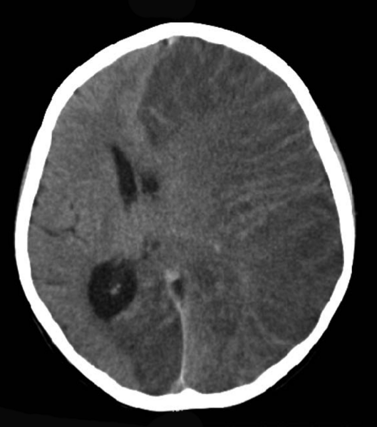 Archivo:CT scan Rasmussen's encephalitis.png