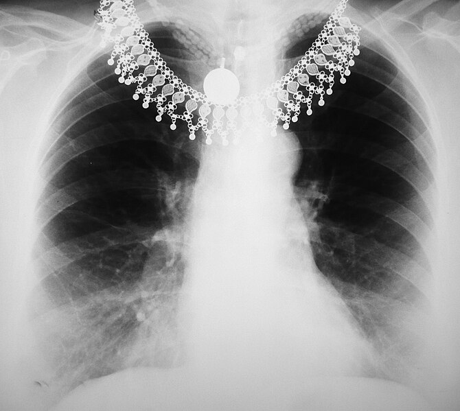 Файл:Chest X-ray 1300274 cr.jpg