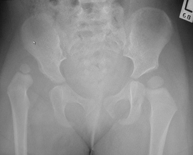 File:Dislocated hip.jpg