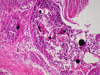 "Cutaneous mercury granuloma is a rare disorder caused by the introduction of elemental Hg into skin..."