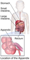 Illustration depicting the location of the appendix in a child