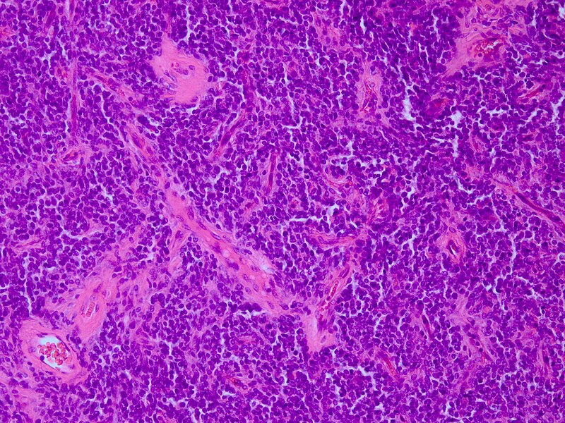 File:PNET Histopathology HE 200x.jpg