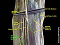 brachial cutaneous nerve