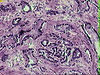 Photomicrograph of invasive prostate adenocarcinoma